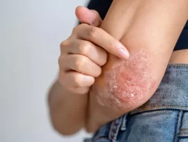 asian-woman-with-acute-psoriasis-her-elbows.jpg
